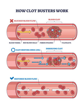 Clot busters work by dissolving blood clots in vessels, restoring blood flow, key objects, blood clot, drug, blood vessel. Outline diagram