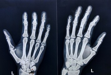 Naklejka premium x ray image of human hand.