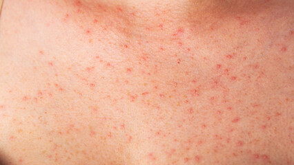 Red pimples and rashes on female skin. Concept of chronic dermatological diseases, allergy to...