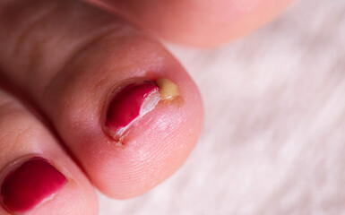 Healthy nail care tips for preventing ingrown toenails and promoting foot health