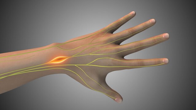 Median Nerve Schwannoma in Hand