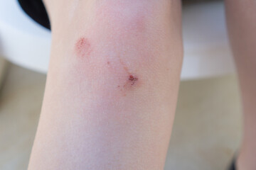 Close up of an injured knee with multiple minor scrapes and scabs