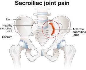Sacroiliac joint pain. Arthritic sacroliac joint illustration