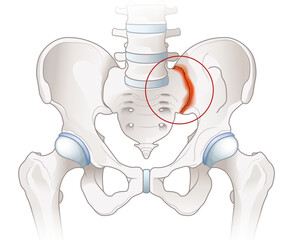 Sacroiliac joint pain. Arthritic sacroliac joint illustration