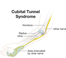 Cubital Tunnel Syndrome. Illustration of Ulnar Nerve Compression in the Elbow