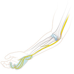 Cubital Tunnel Syndrome. Illustration of Ulnar Nerve Compression in the Elbow