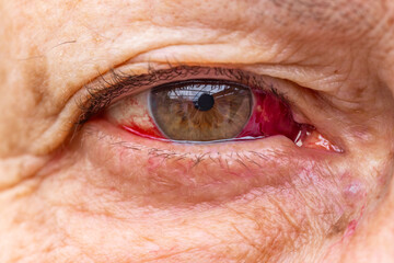 Elderly woman with eye injury and bleeding indoors during daytime