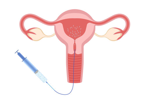 Fertilization icon. IUI treatment. Intrauterine fertilization. Donor sperm. Intrauterine insemination IUI. Infertility treatment. EPS10 Vector illustration