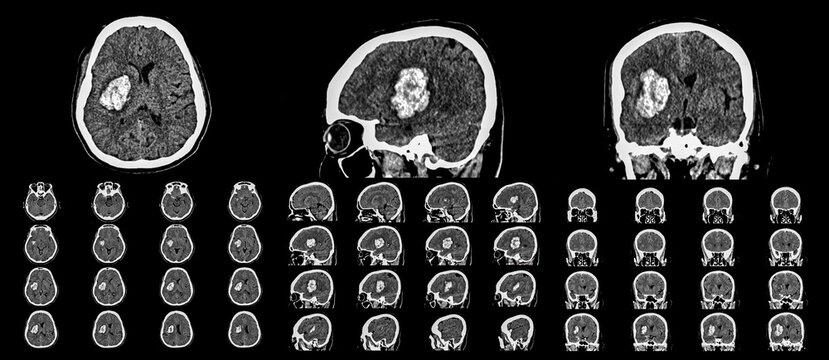 CT scan brain image showing intracerebral hemorrhage stroke