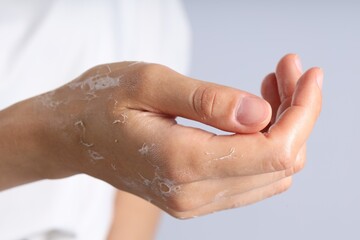 Fototapeta premium Woman with dry skin on her hand against light background, closeup