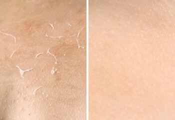 Fototapeta premium Dry skin on one side and moisturized on another, collage before and after