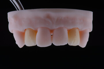 High-quality dental single crowns made of zirconium for fixation to the frontal teeth of upper jaw.