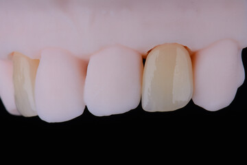 High-quality dental single crowns made of zirconium for fixation to the frontal teeth of upper jaw.