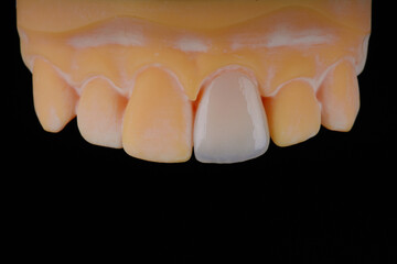 Mirror copy of central maxillary incisor, ultra thin dental ceramic veneer or crown on printed model