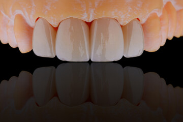 High-quality four dental crowns made of zirconium for fixation to the frontal teeth of upper jaw.