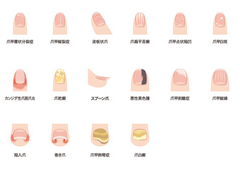 爪の病気一覧