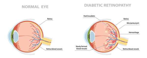 Normal eye and one affected by diabetic retinopathy. Medical science educational flat vector illustration.