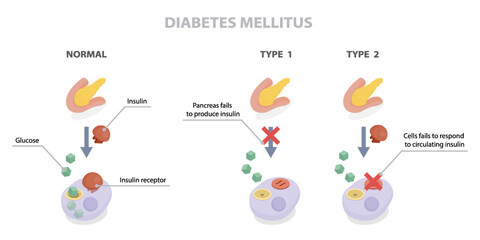 Diabetes mellitus. Difference between type one diabetes and type two diabetes. Flat isometric vector illustration diagram. Educational medical information banner.