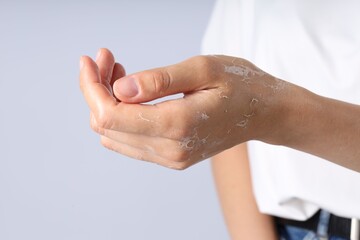 Woman with dry skin on her hand against light background, closeup