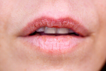 Obraz premium Female mouth showing dry chapped cracked lips