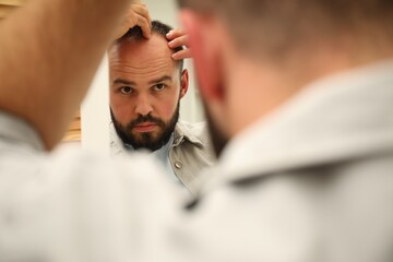 Baldness problem. Man with receding hairline near mirror at home