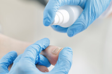 Podiatrist applying treatment to toenail of caucasian adult, pedicure
