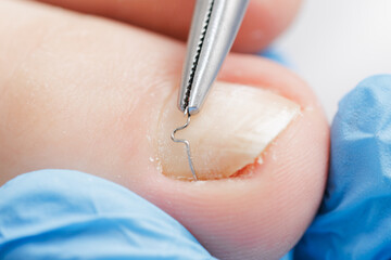 Podiatrist treating ingrown toenail with wire brace technique