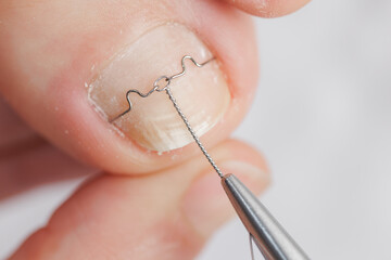 Toe nail correction by podiatrist using brace technique on young caucasian adult