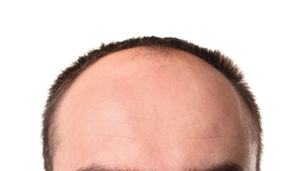 Fototapeta premium Baldness problem. Man with receding hairline on white background, closeup