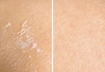 Fototapeta premium Dry skin on one side and moisturized on another, collage before and after