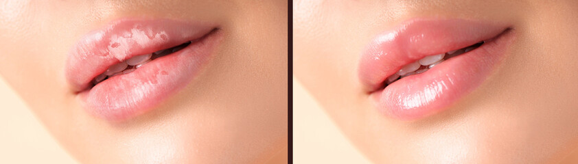 Fototapeta premium Lip care. Woman with chapped and dry skin before and healthy skin after moisturizing treatment, collage