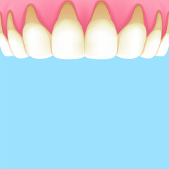 Upper teeth (Recession gums) - Text box banner (square) illustration vector design. Dental care concept.