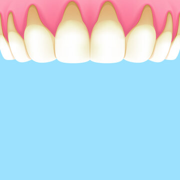 Upper teeth (Recession gums) - Text box banner (square) illustration vector design. Dental care concept.