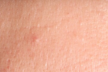 Human skin with acne problem, macro view. Detailed texture of surface