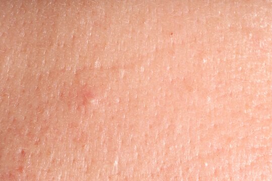 Human skin with acne problem, macro view. Detailed texture of surface