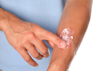Man applying healing cream onto burned hand on white background, closeup
