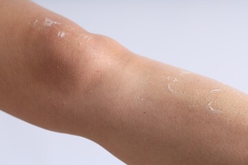 Woman with dry skin on her leg against light background, closeup