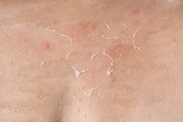 Closeup view of woman with dry skin