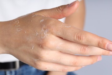 Woman with dry skin on her hand against light background, closeup