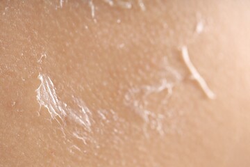 Closeup view of woman with dry skin