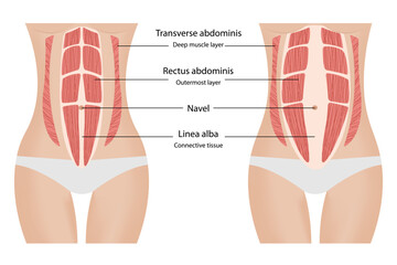 Variations of diastasis recti. Separation of the muscles
