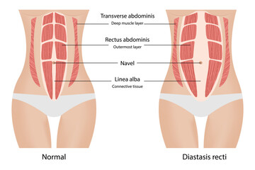 Diastasis recti. Separation of the muscles