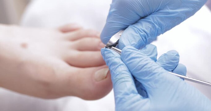 Detail of podiatrist treating ingrown toenail with brace titanium thread correction technique.
