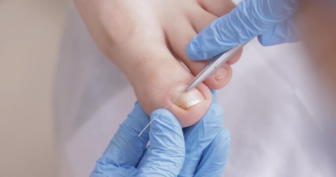 Podiatrist treating toenail with wire technique.