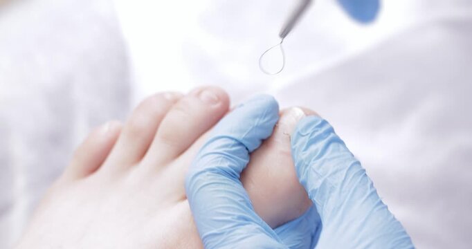 Podiatrist use podological brace titanium thread on toenail for treatment ingrown nail of women, pedicure on white background.