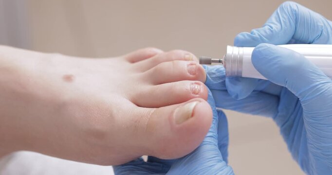Podiatrist treating patient toenails with precision care.