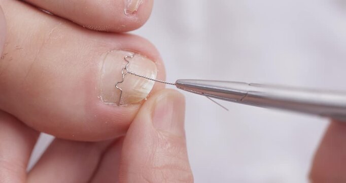 Podological brace titanium thread on toenail for treatment ingrown nail of women, pedicure on white background.