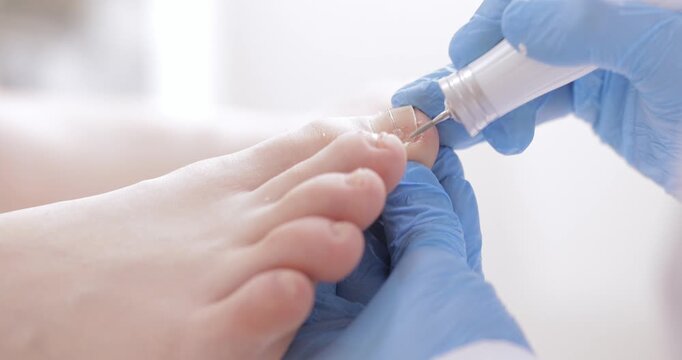 Professional podiatrist use podological brace titanium thread on toe nail with onychocryptosis or ingrown toenail, orthonyxia pedicure treatment on white background.