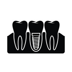 Dental implant illustration showing tooth root and bone structure