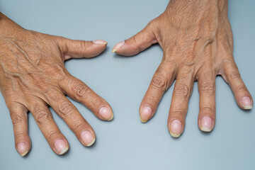 Medical themes: Patiente with nail clubbing from lung cancer disease. Paraneoplastic Syndrome